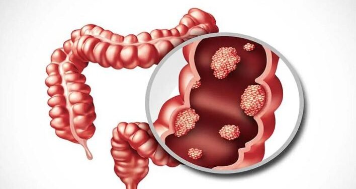 علماء كوريون يحولون خلايا سرطان القولون إلى خلايا طبيعية دون الحاجة إلى تدميرها